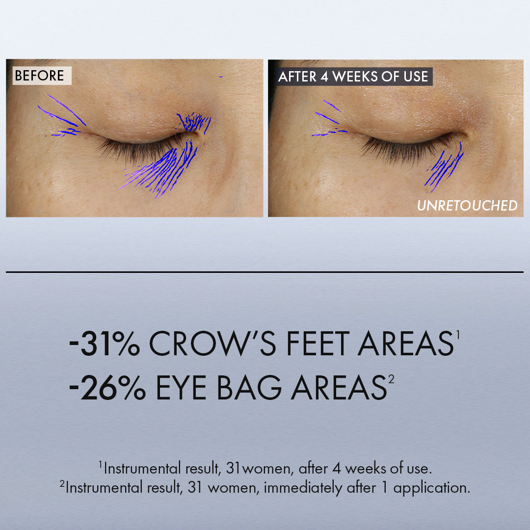 Before and after of improvement in crow's feet and eye bag areas